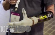How Bionic Limbs Are Changing Lives